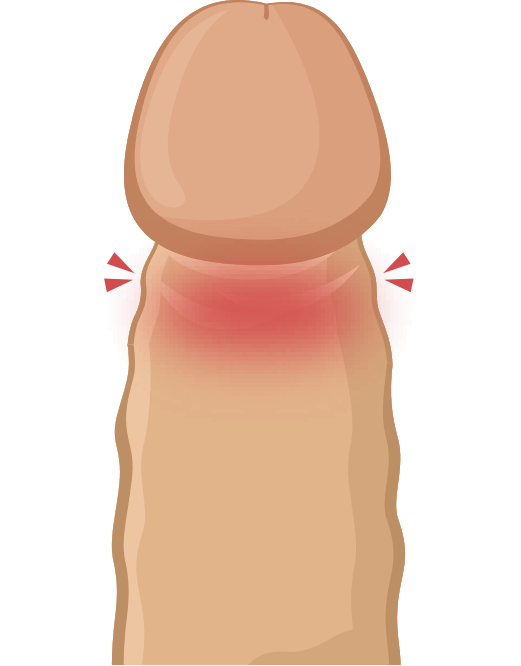 嵌頓(カントン)包茎